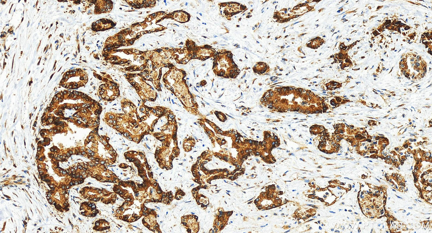 Immunohistochemistry (IHC) staining of human intrahepatic cholangiocarcinoma tissue using G3BP2 Recombinant antibody (82080-4-RR)