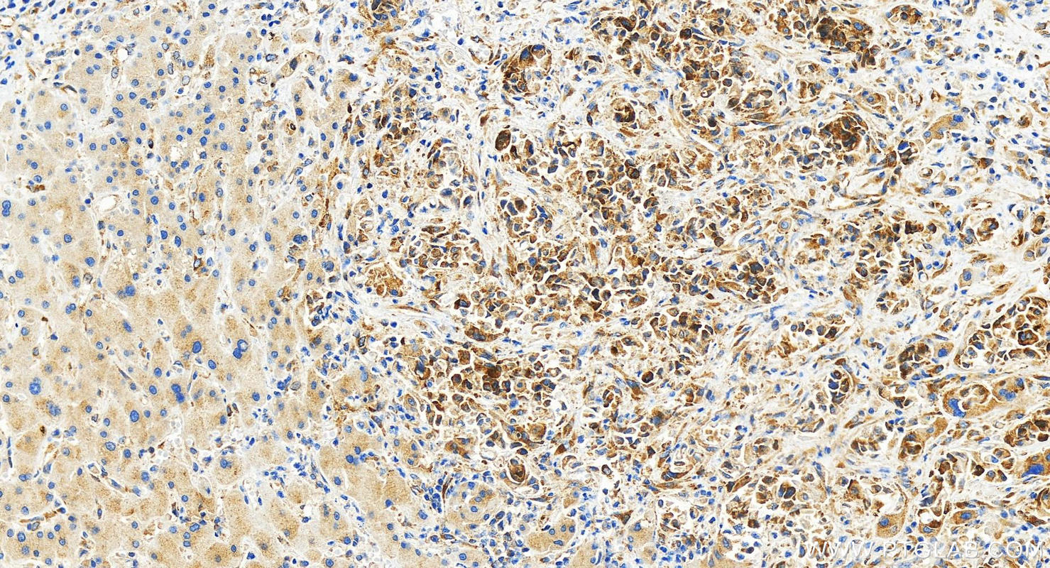 Immunohistochemistry (IHC) staining of human intrahepatic cholangiocarcinoma tissue using G3BP2 Recombinant antibody (82080-6-RR)