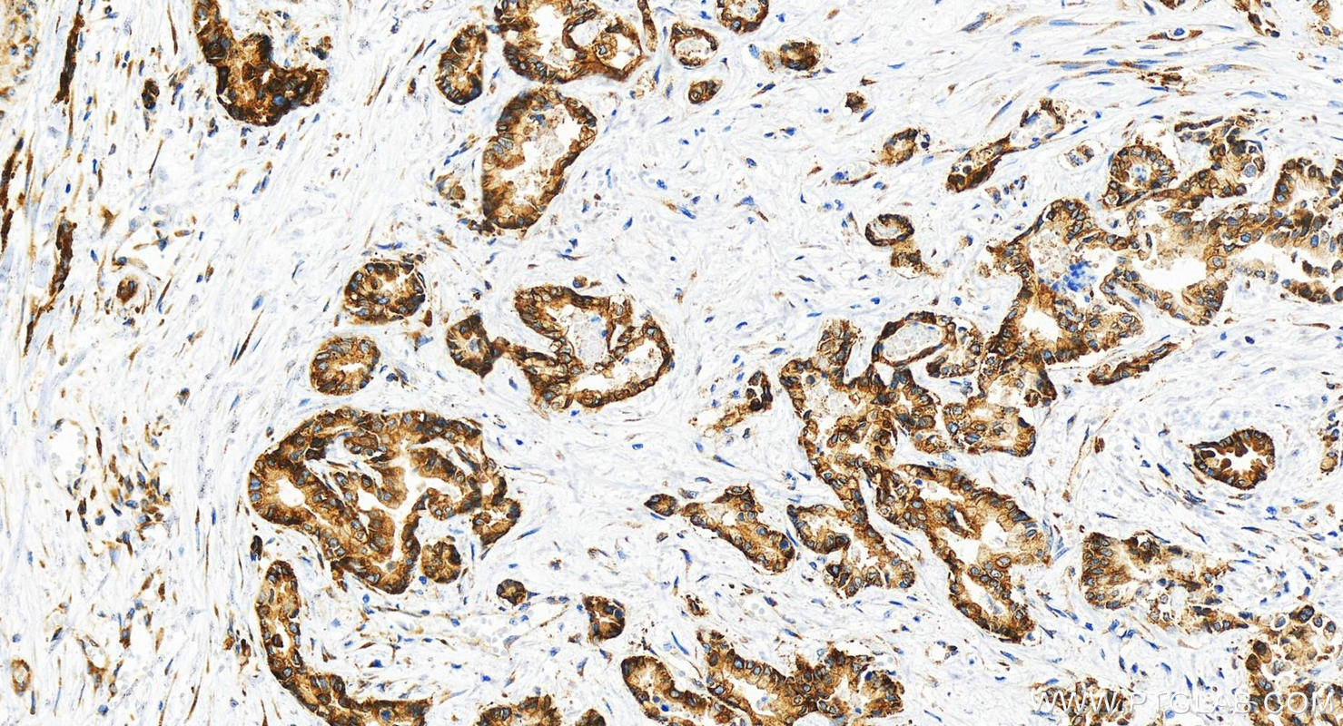 Immunohistochemistry (IHC) staining of human intrahepatic cholangiocarcinoma tissue using G3BP2 Recombinant antibody (82080-6-RR)