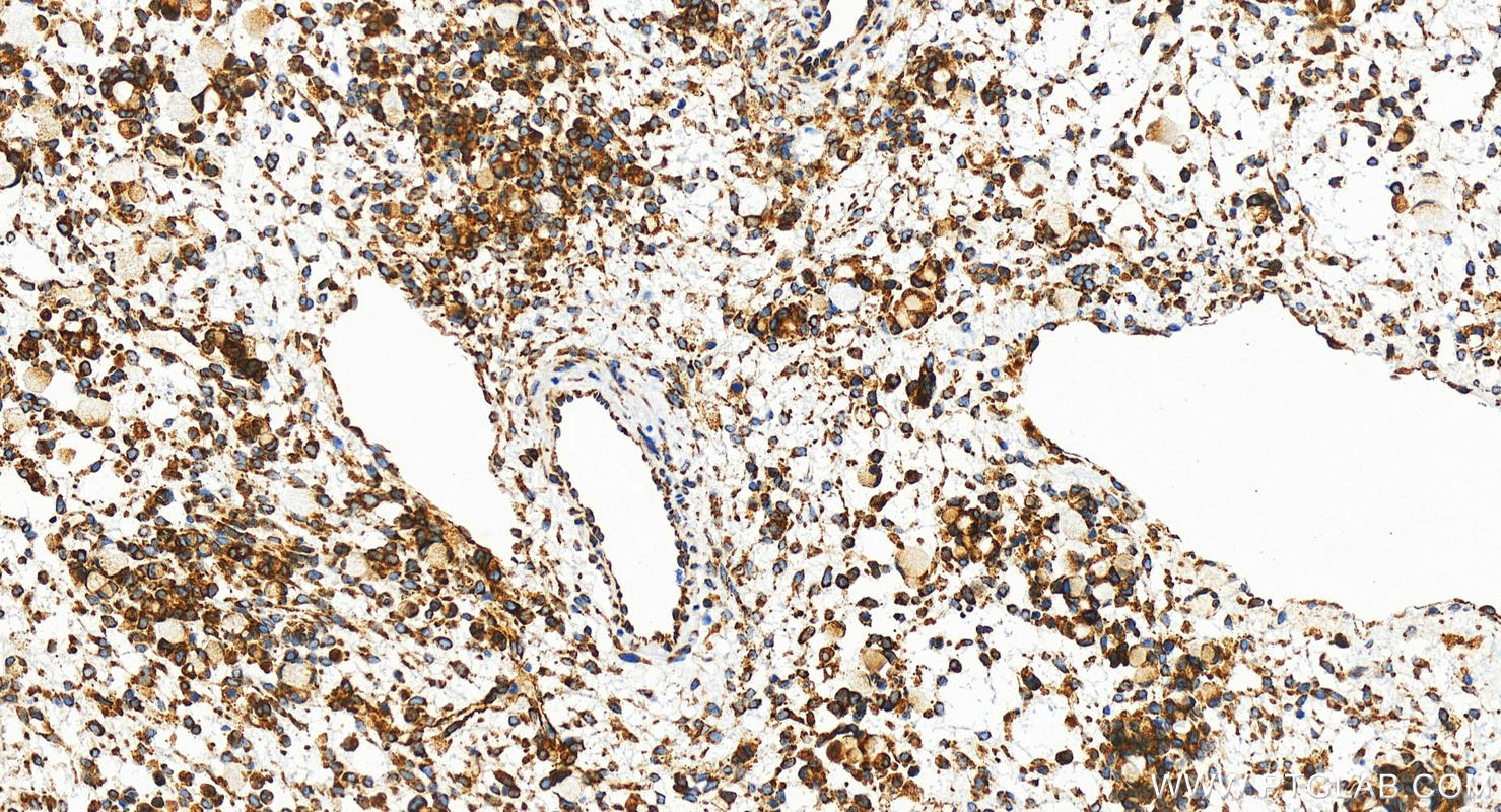 Immunohistochemistry (IHC) staining of human ovary cancer tissue using G3BP2 Recombinant antibody (82080-6-RR)