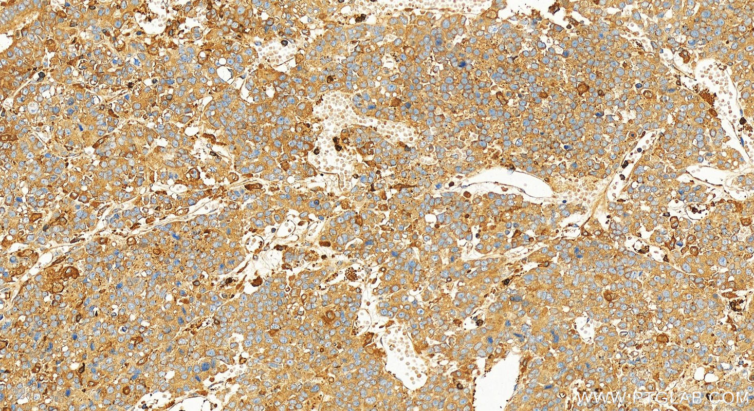 Immunohistochemistry (IHC) staining of human hepatocellular carcinoma using G6PD Polyclonal antibody (25413-1-AP)