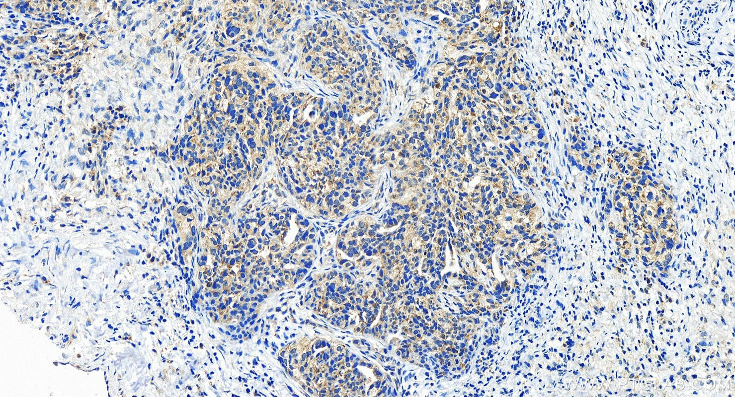 Immunohistochemistry (IHC) staining of human ovary cancer tissue using GABARAP Polyclonal antibody (22439-1-AP)