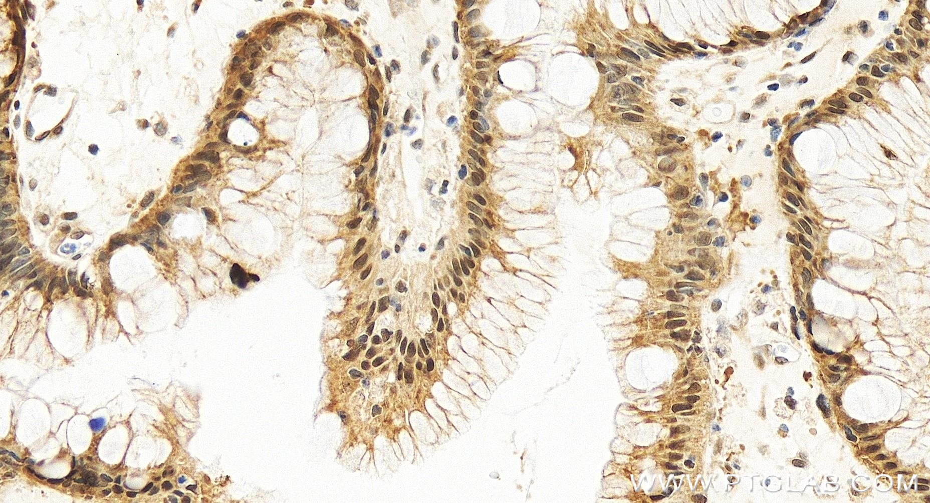 Immunohistochemistry (IHC) staining of human stomach cancer tissue using GADD45A Recombinant antibody (84376-3-RR)