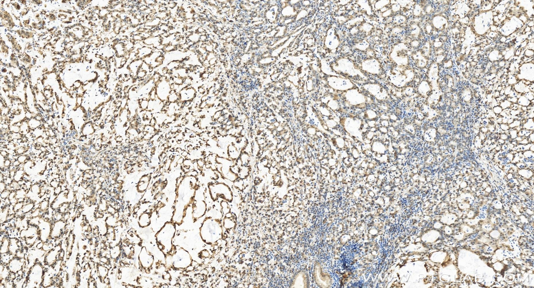 Immunohistochemistry (IHC) staining of human stomach cancer tissue using GADD45A Recombinant antibody (84376-3-RR)