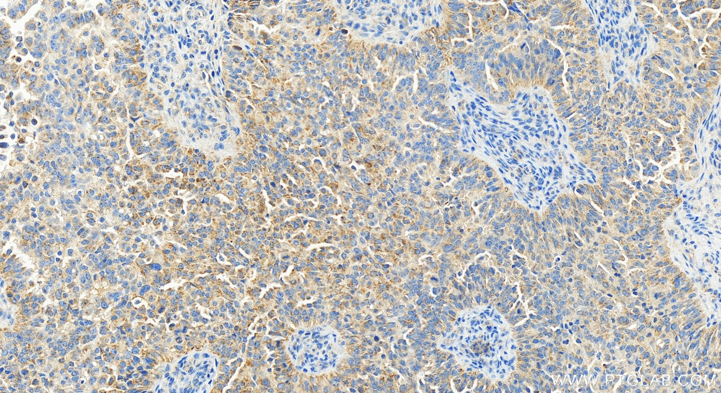 Immunohistochemistry (IHC) staining of human ovarian  cancer using GADD45GIP1 Recombinant antibody (83823-5-RR)