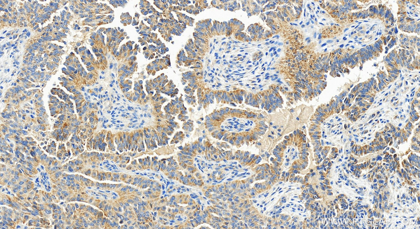 Immunohistochemistry (IHC) staining of human ovarian  cancer using GADD45GIP1 Recombinant antibody (83823-5-RR)