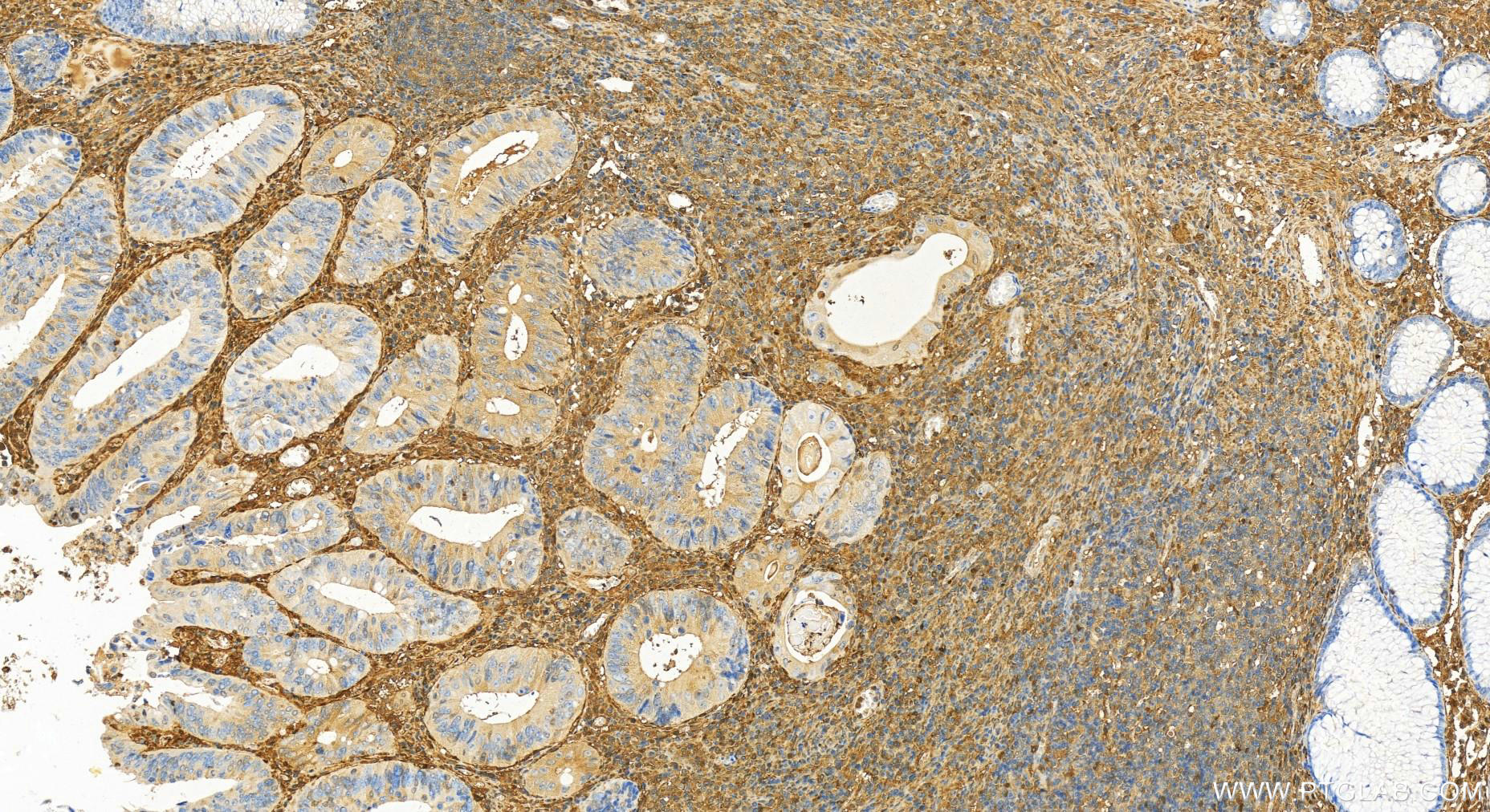 Immunohistochemistry (IHC) staining of human colon cancer tissue using Galectin-1 Polyclonal antibody (11858-1-AP)