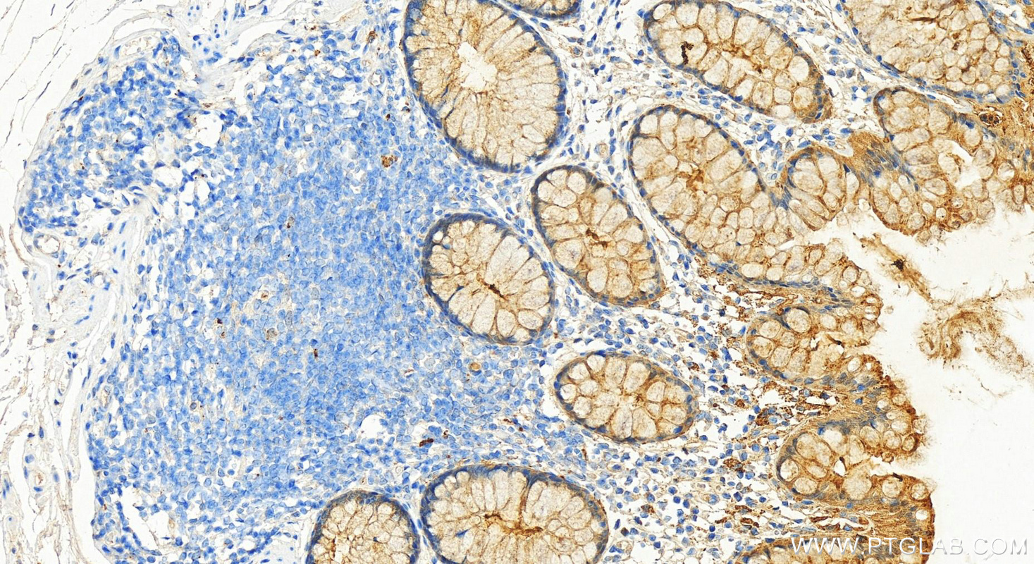 Immunohistochemistry (IHC) staining of human colon tissue using Galectin-3 Polyclonal antibody (14979-1-AP)