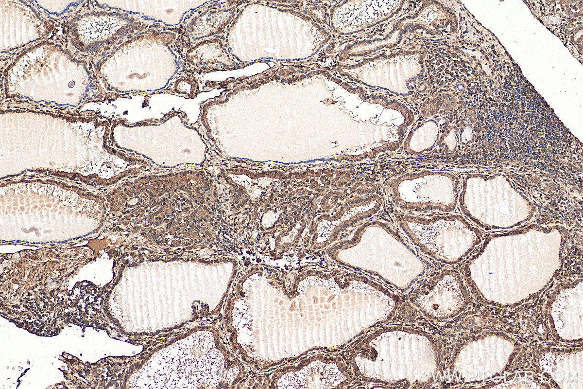 Immunohistochemistry (IHC) staining of human thyroid cancer tissue using Galectin-3 Polyclonal antibody (14979-1-AP)