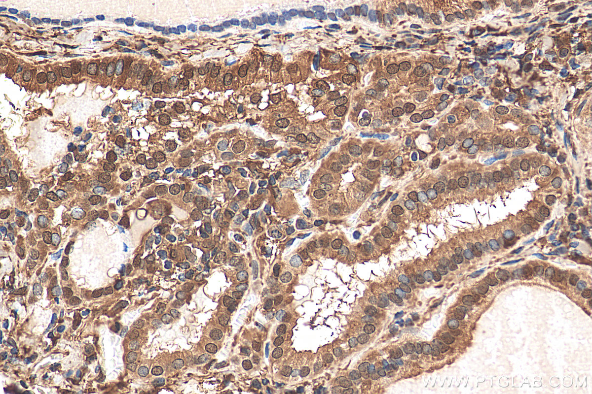 Immunohistochemistry (IHC) staining of human thyroid cancer tissue using Galectin-3 Polyclonal antibody (14979-1-AP)