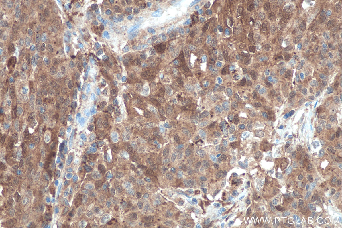 Immunohistochemistry (IHC) staining of human stomach cancer tissue using Galectin-3 Monoclonal antibody (60207-1-Ig)