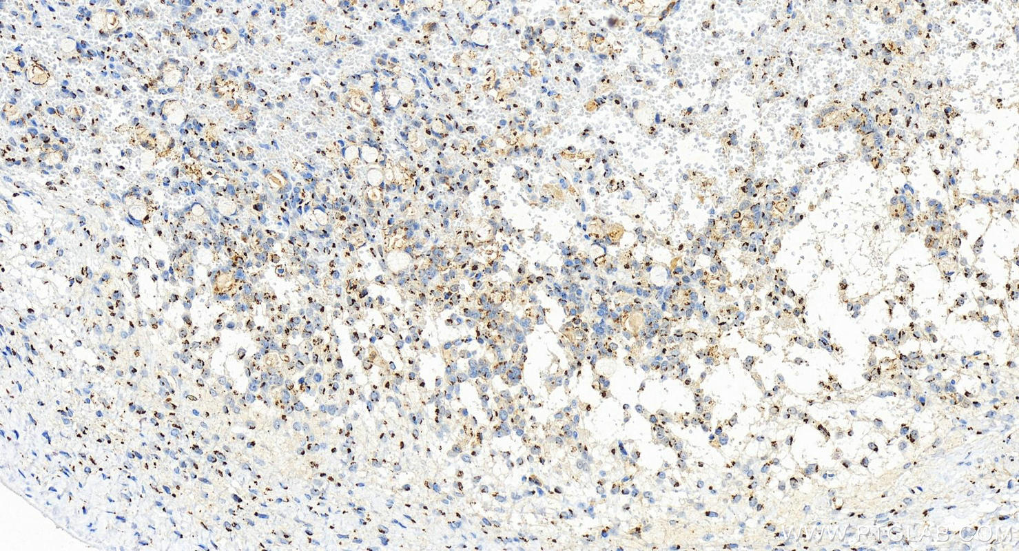 Immunohistochemistry (IHC) staining of human ovary cancer tissue using GALNT2 Recombinant antibody (83703-2-RR)