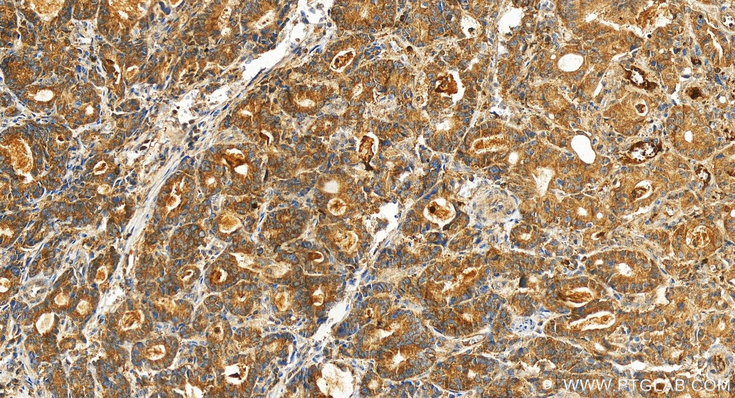 Immunohistochemistry (IHC) staining of human stomach cancer tissue using RAP1GAP2 Polyclonal antibody (25391-1-AP)