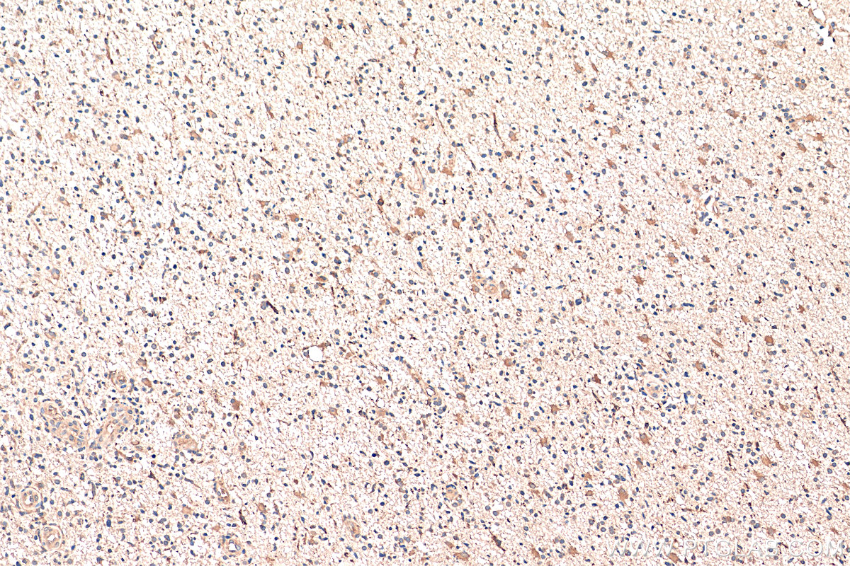 Immunohistochemistry (IHC) staining of human gliomas tissue using GAS1 Polyclonal antibody (17903-1-AP)