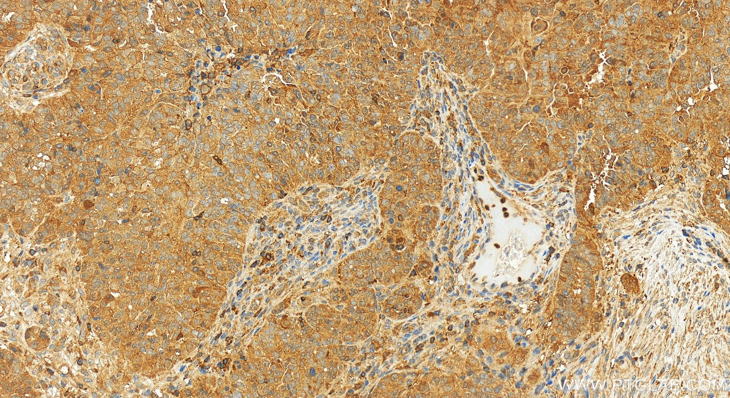 Immunohistochemistry (IHC) staining of human ovarian  cancer using GCLM Recombinant antibody (82623-1-RR)