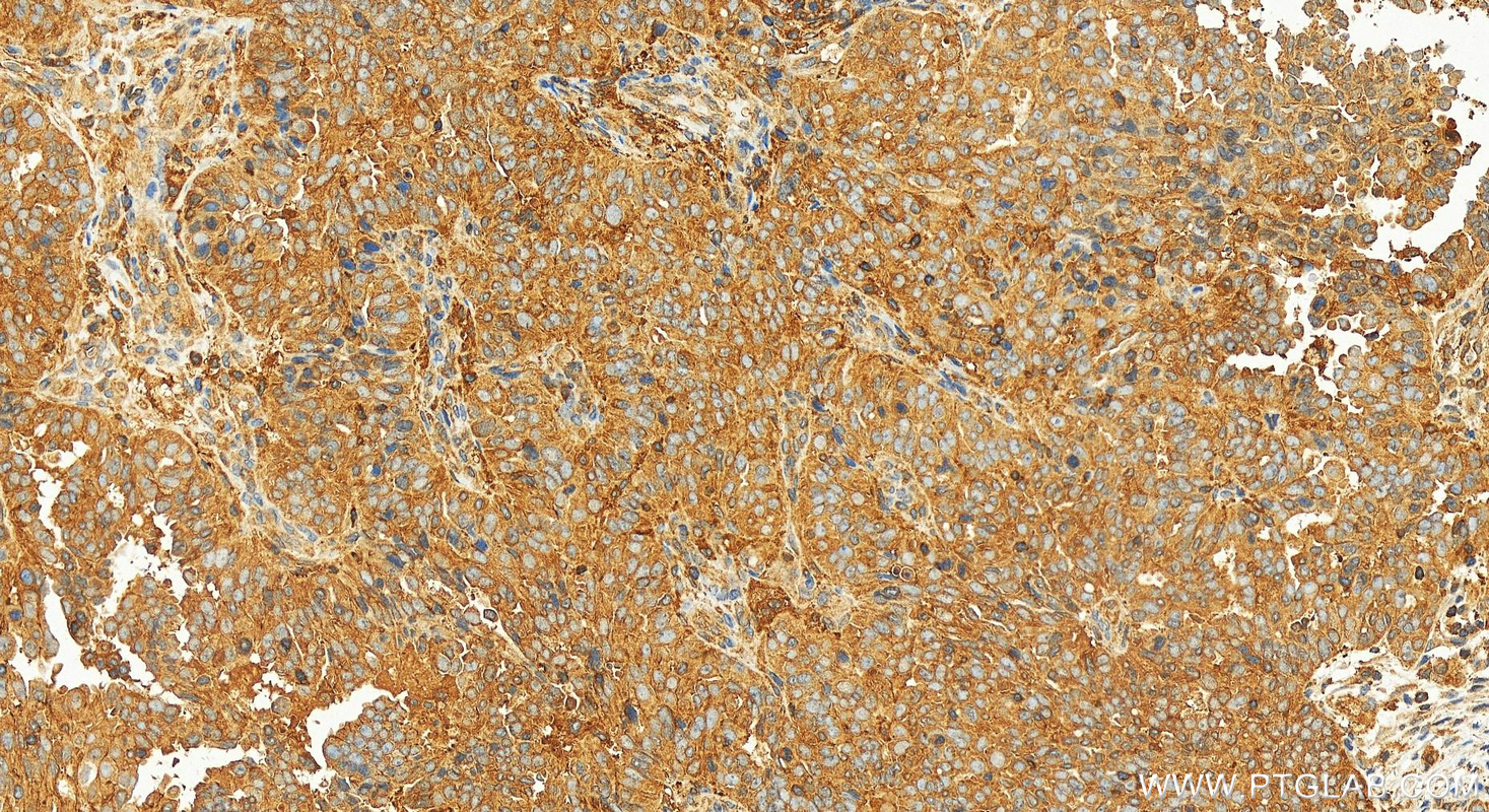 Immunohistochemistry (IHC) staining of human ovarian  cancer using GCLM Recombinant antibody (82623-1-RR)