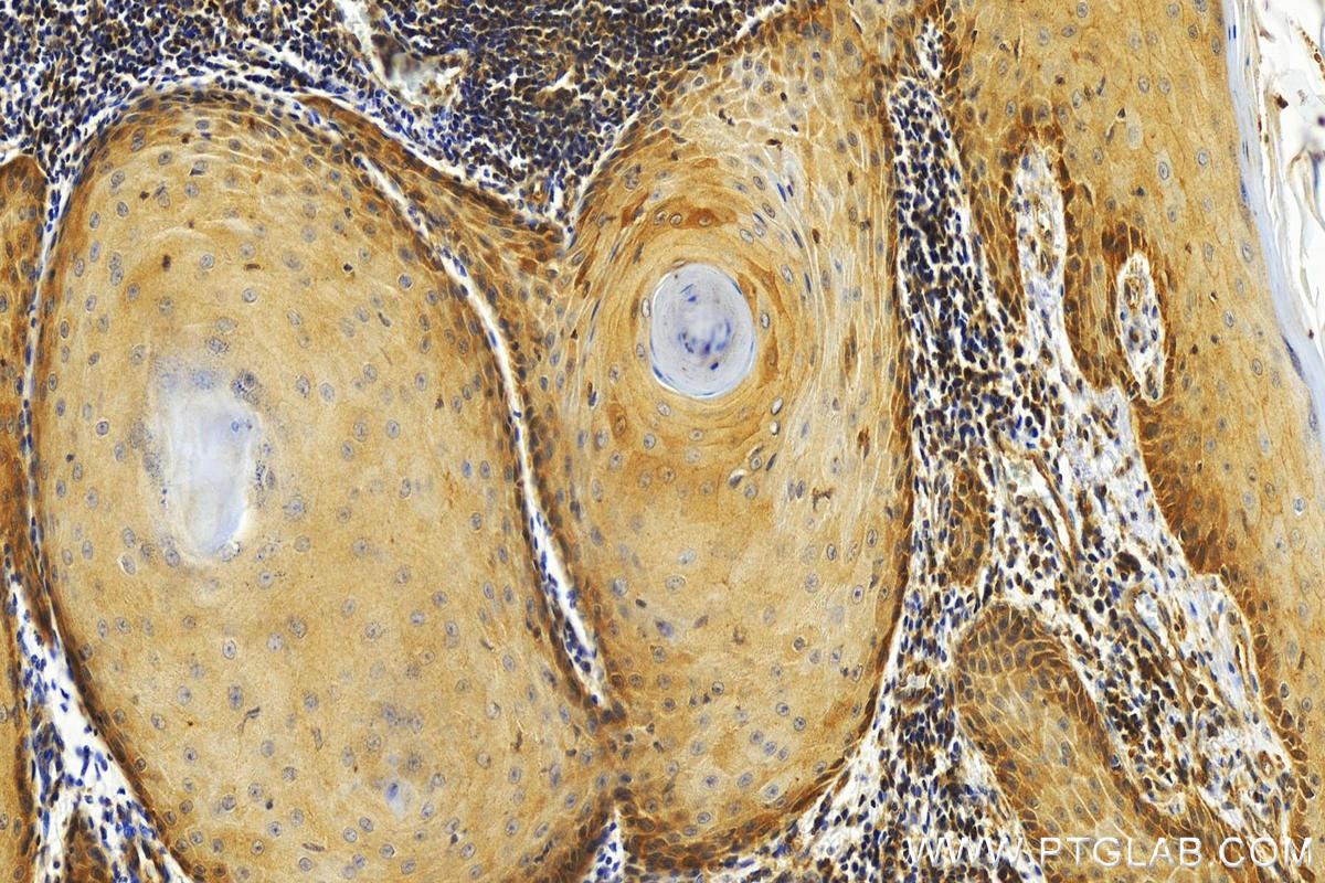 Immunohistochemistry (IHC) staining of human skin cancer tissue using GCLM Recombinant antibody (82623-1-RR)