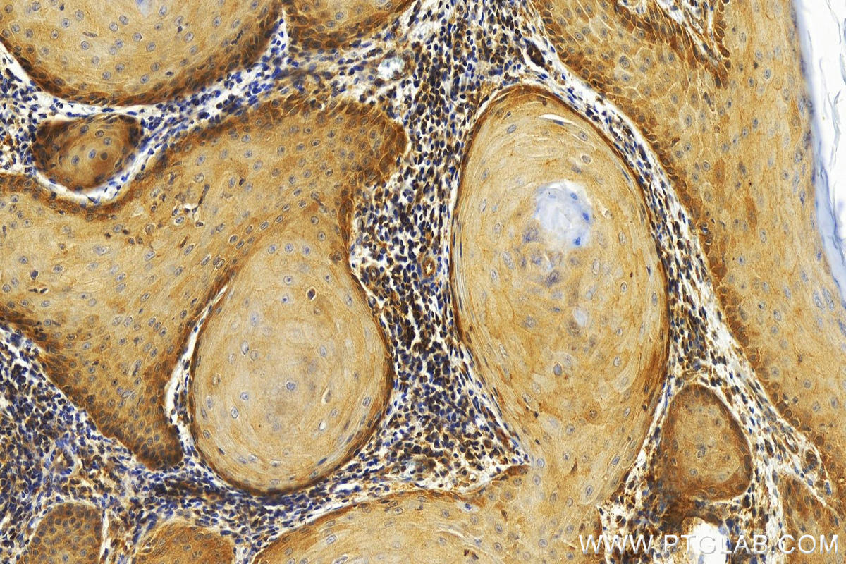 Immunohistochemistry (IHC) staining of human skin cancer tissue using GCLM Recombinant antibody (82623-1-RR)