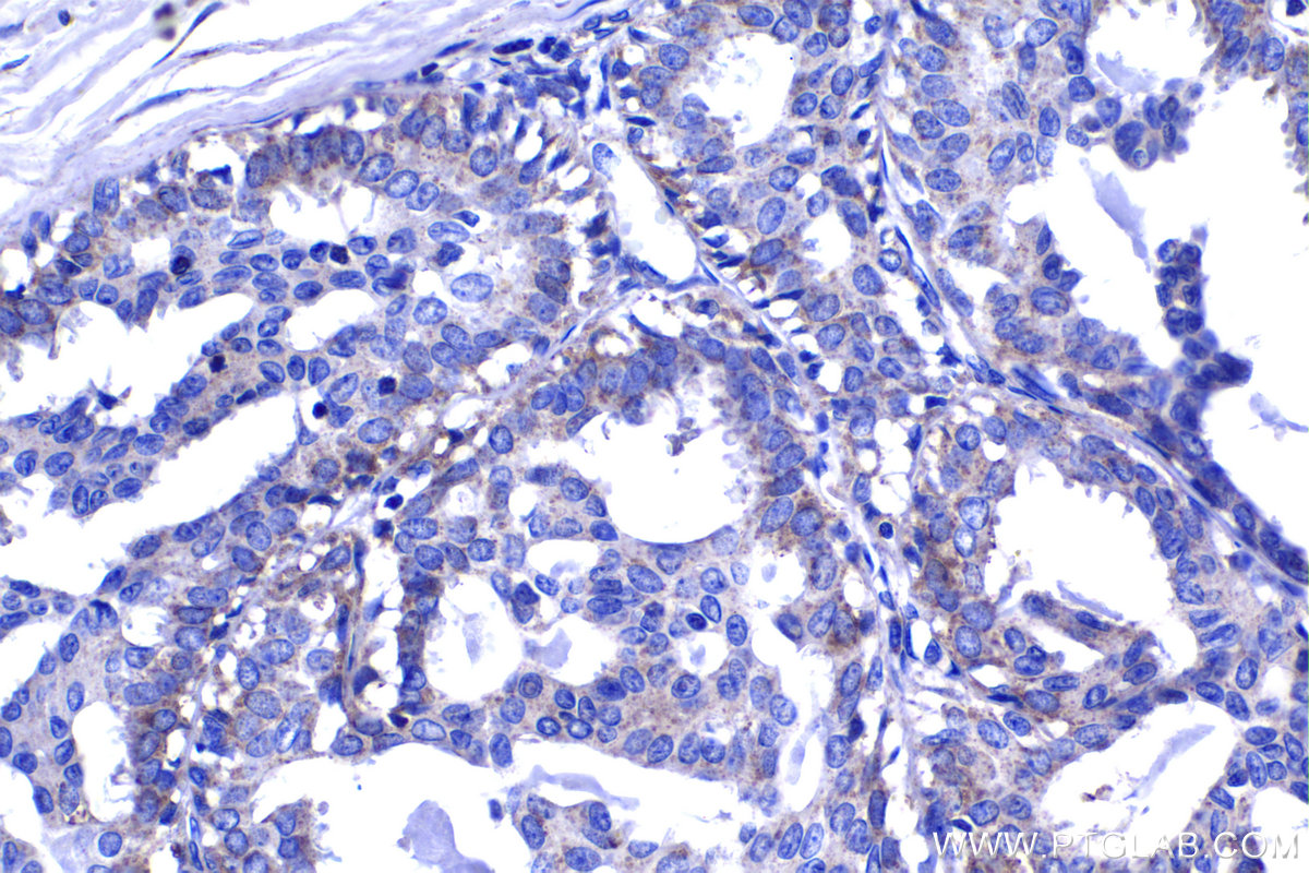 Immunohistochemistry (IHC) staining of human breast cancer tissue using GCNT2 Polyclonal antibody (18118-1-AP)