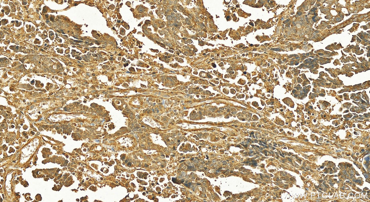 Immunohistochemistry (IHC) staining of human ovary cancer tissue using GCSH Polyclonal antibody (16726-1-AP)