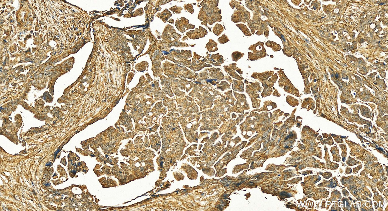 Immunohistochemistry (IHC) staining of human ovary cancer tissue using GCSH Polyclonal antibody (16726-1-AP)