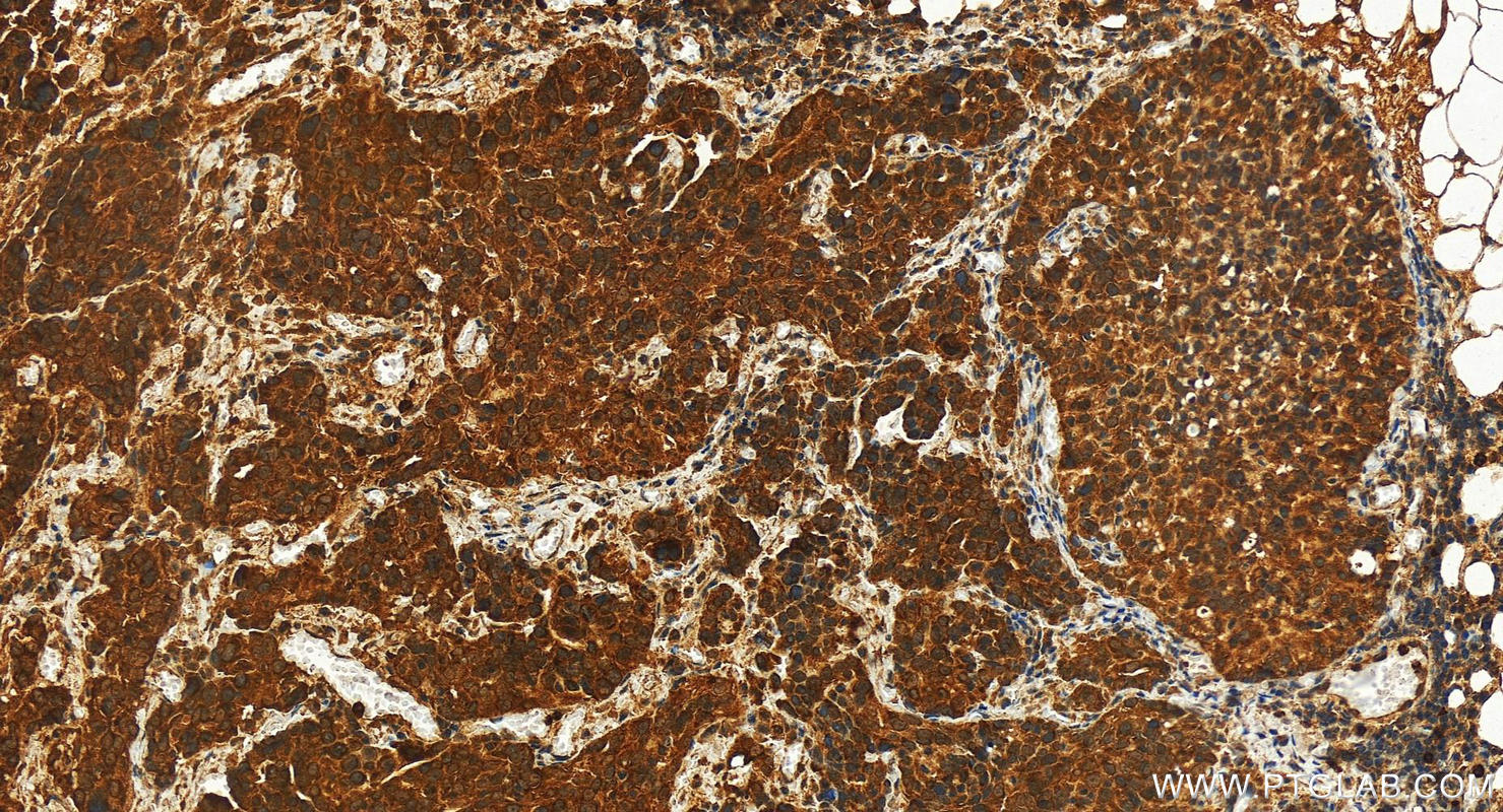 Immunohistochemistry (IHC) staining of human ovary cancer tissue using GEMIN7 Polyclonal antibody (10625-1-AP)