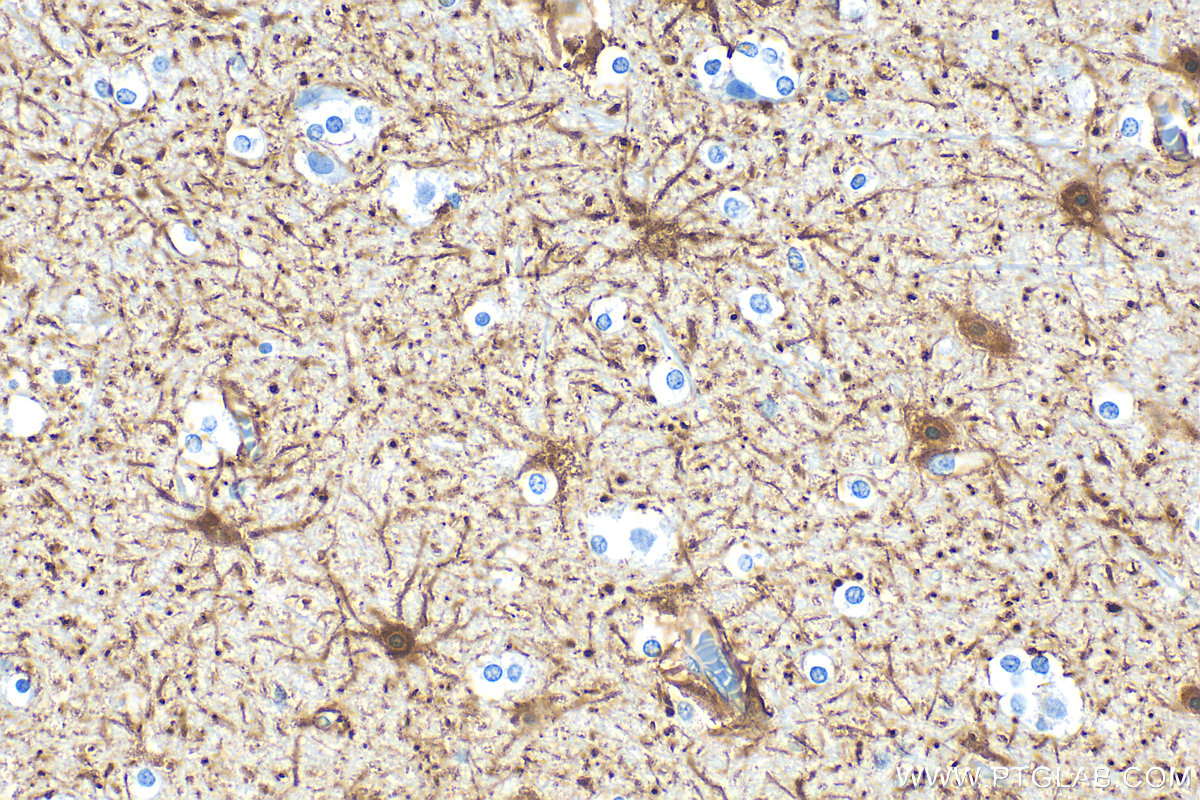 Immunohistochemistry (IHC) staining of human brain tissue using GFAP Polyclonal antibody (16825-1-AP)