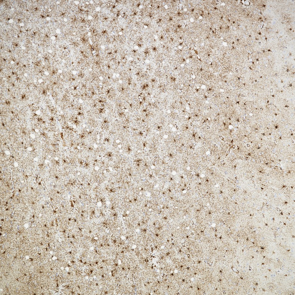 Immunohistochemistry (IHC) staining of human brain tissue using GFAP Recombinant monoclonal antibody (81063-1-RR)