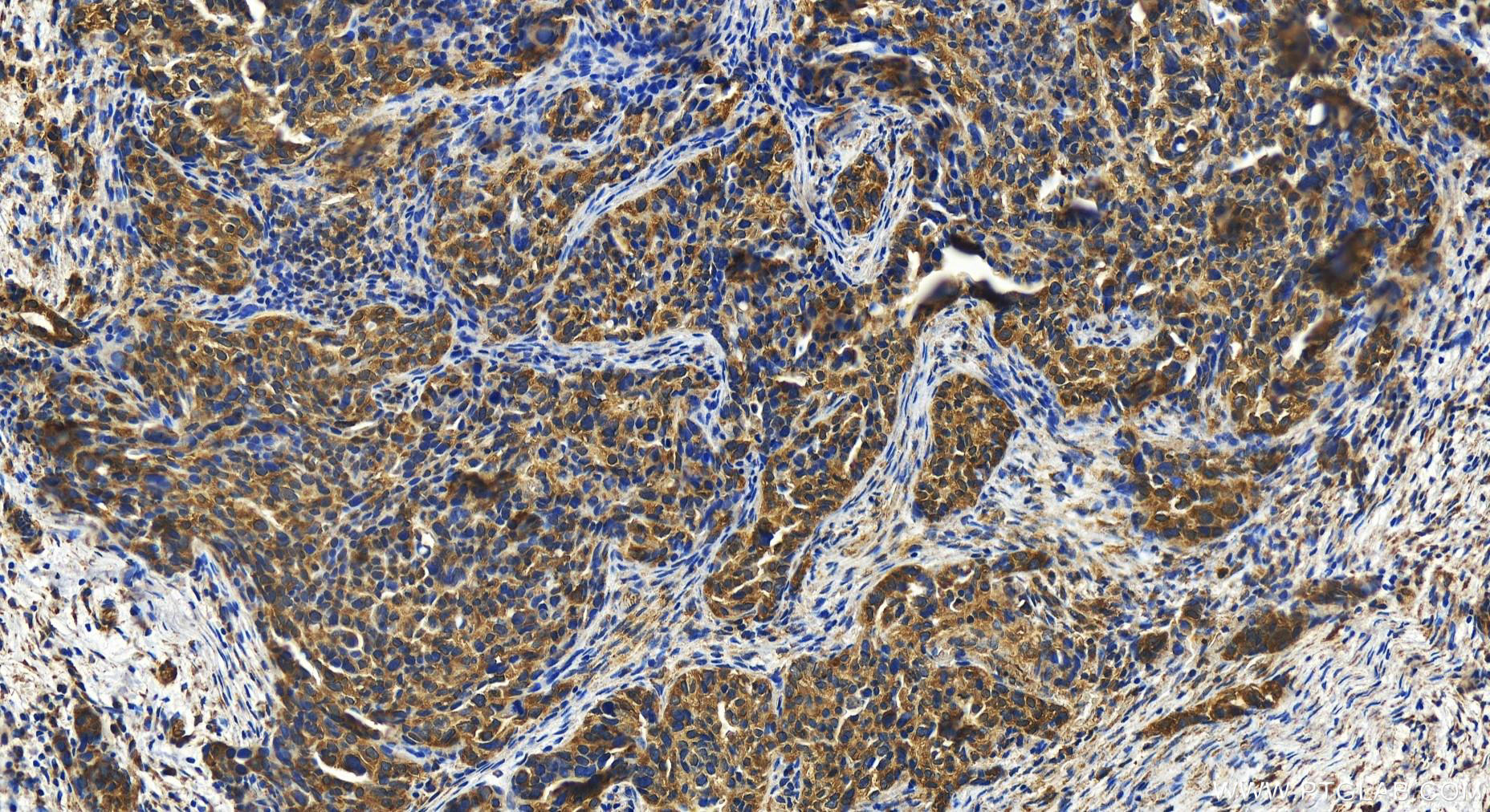 Immunohistochemistry (IHC) staining of human ovary cancer tissue using GFPT2 Polyclonal antibody (15189-1-AP)