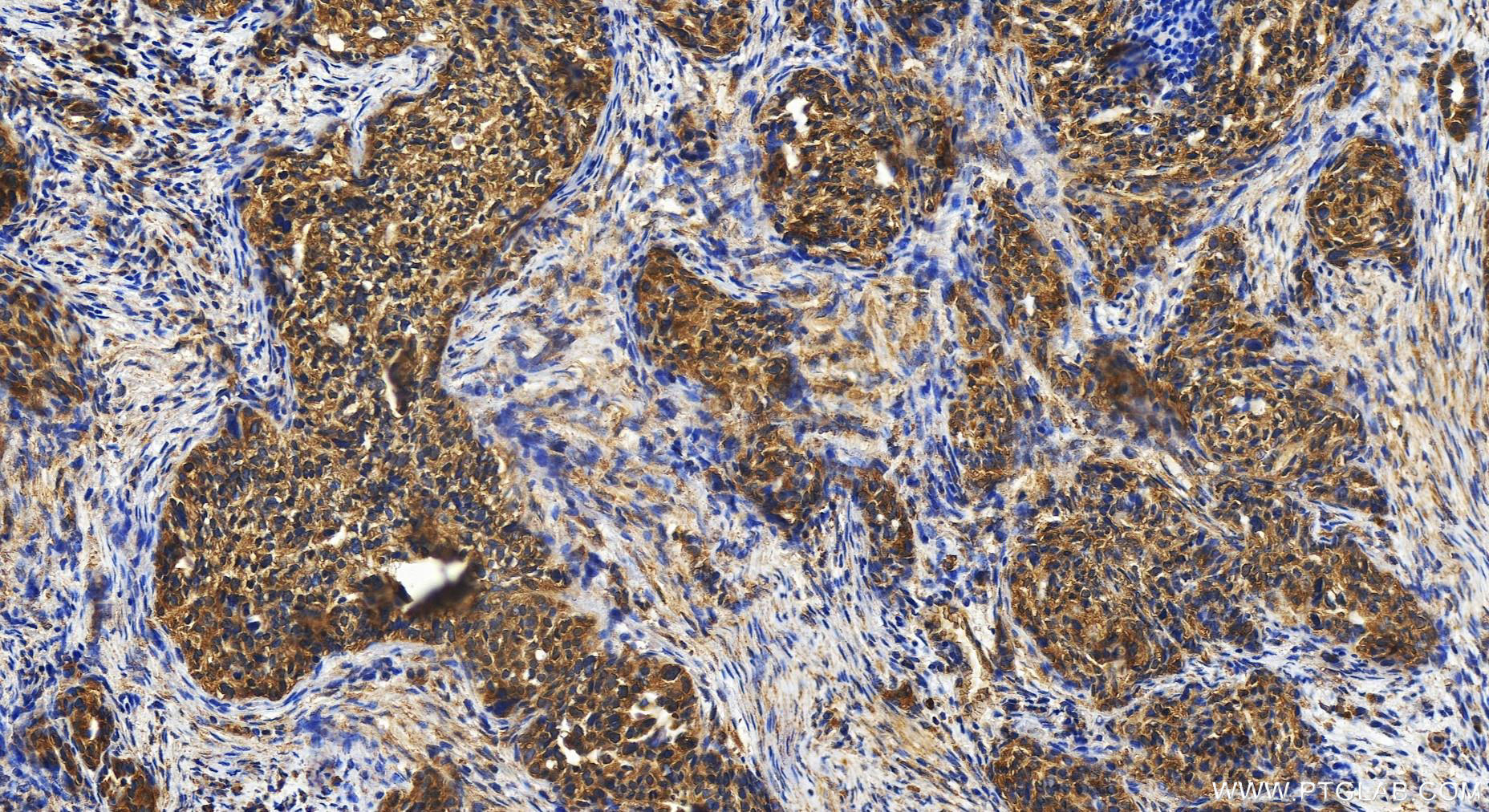 Immunohistochemistry (IHC) staining of human ovary cancer tissue using GFPT2 Polyclonal antibody (15189-1-AP)