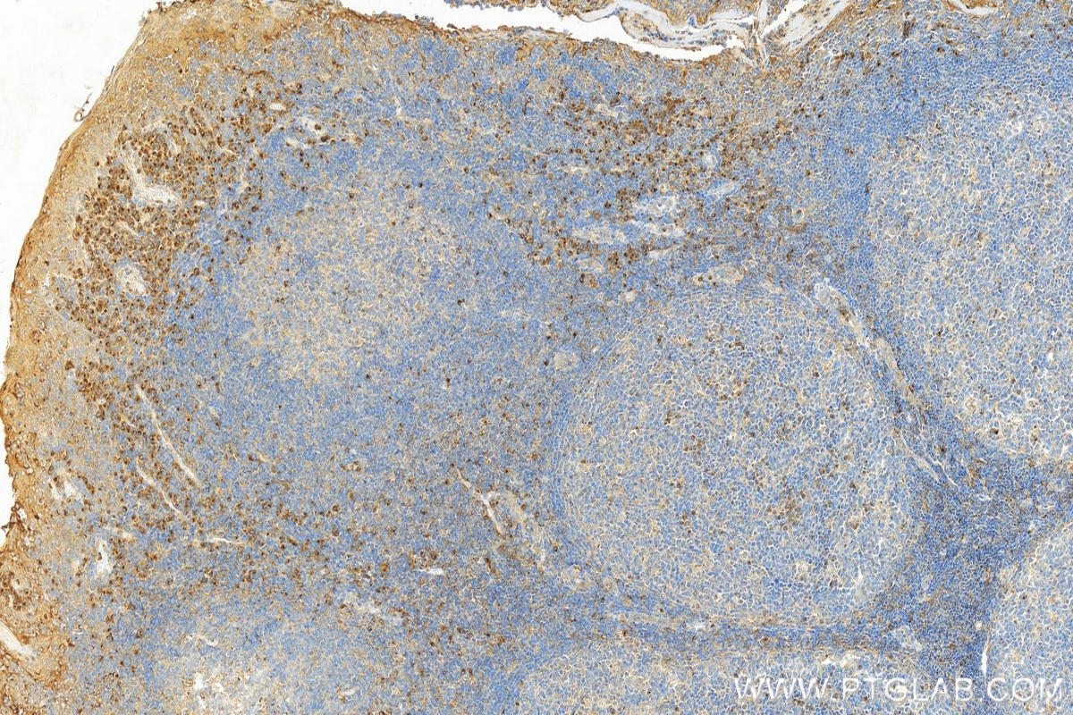 Immunohistochemistry (IHC) staining of human tonsillitis tissue using VISTA Polyclonal antibody (24849-1-AP)