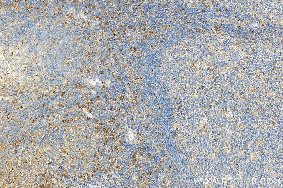 Immunohistochemistry (IHC) staining of human tonsillitis tissue using VISTA Polyclonal antibody (24849-1-AP)