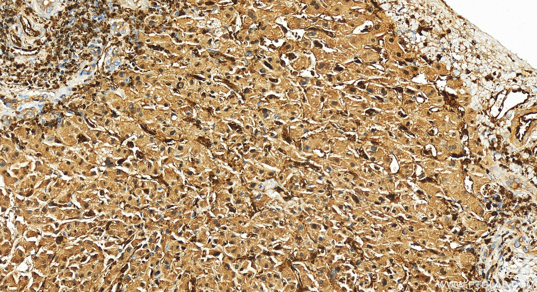 Immunohistochemistry (IHC) staining of human intrahepatic cholangiocarcinoma tissue using GIMAP4 Polyclonal antibody (11852-1-AP)