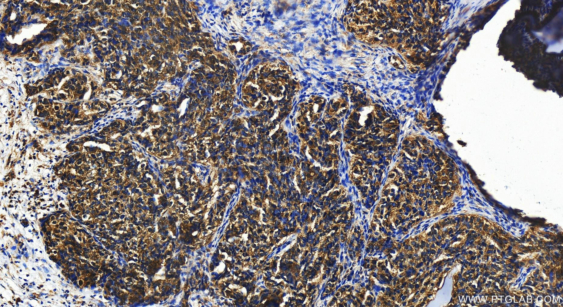 Immunohistochemistry (IHC) staining of human ovary cancer tissue using GINS1 Polyclonal antibody (16061-1-AP)