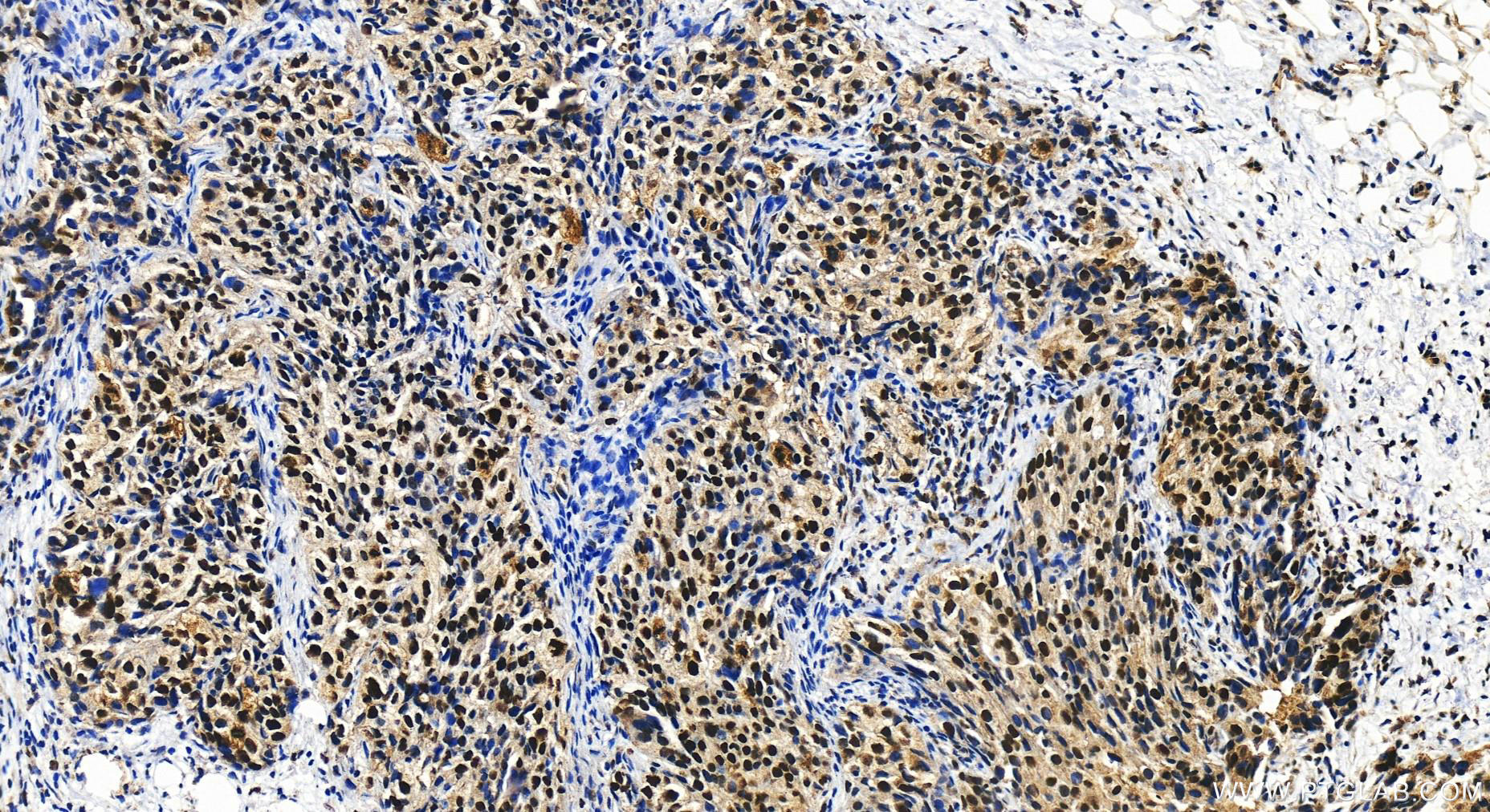 Immunohistochemistry (IHC) staining of human ovary cancer tissue using PSF3 Polyclonal antibody (16345-1-AP)