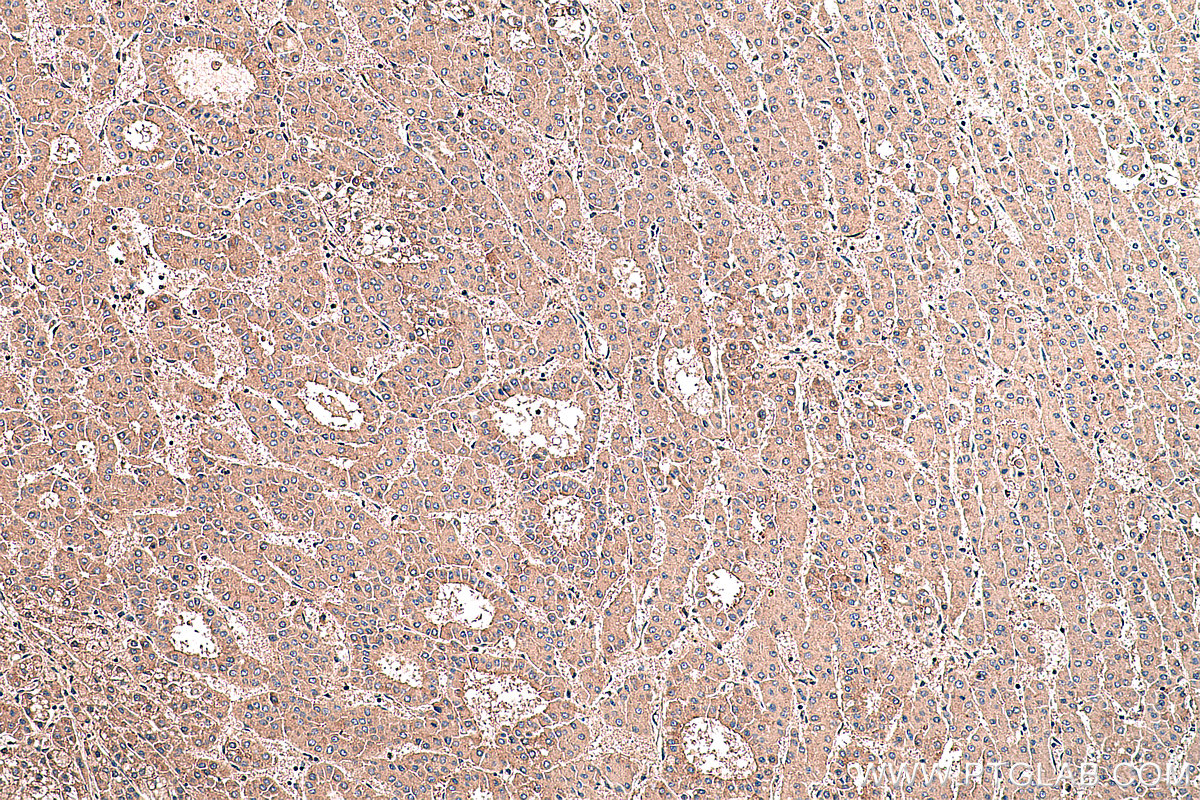 Immunohistochemistry (IHC) staining of human liver cancer tissue using Connexin-32 Polyclonal antibody (10450-1-AP)