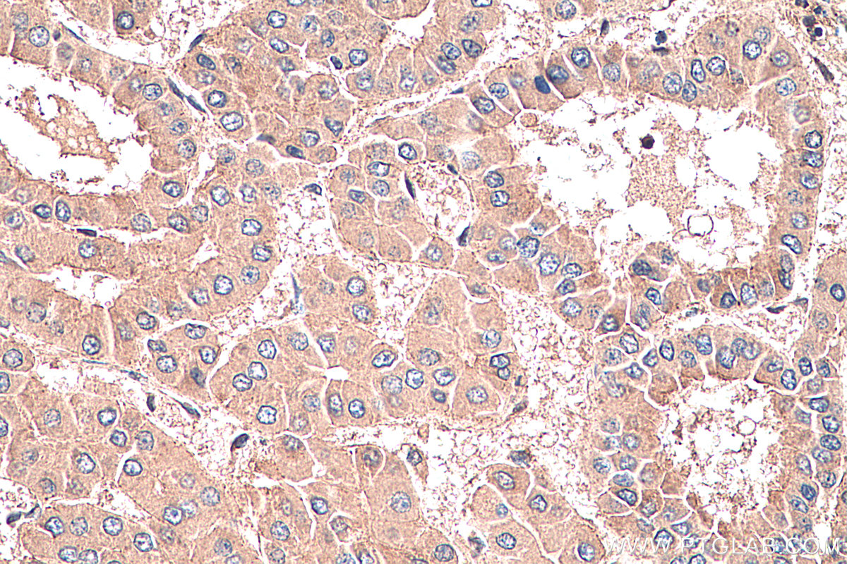 Immunohistochemistry (IHC) staining of human liver cancer tissue using Connexin-32 Polyclonal antibody (10450-1-AP)