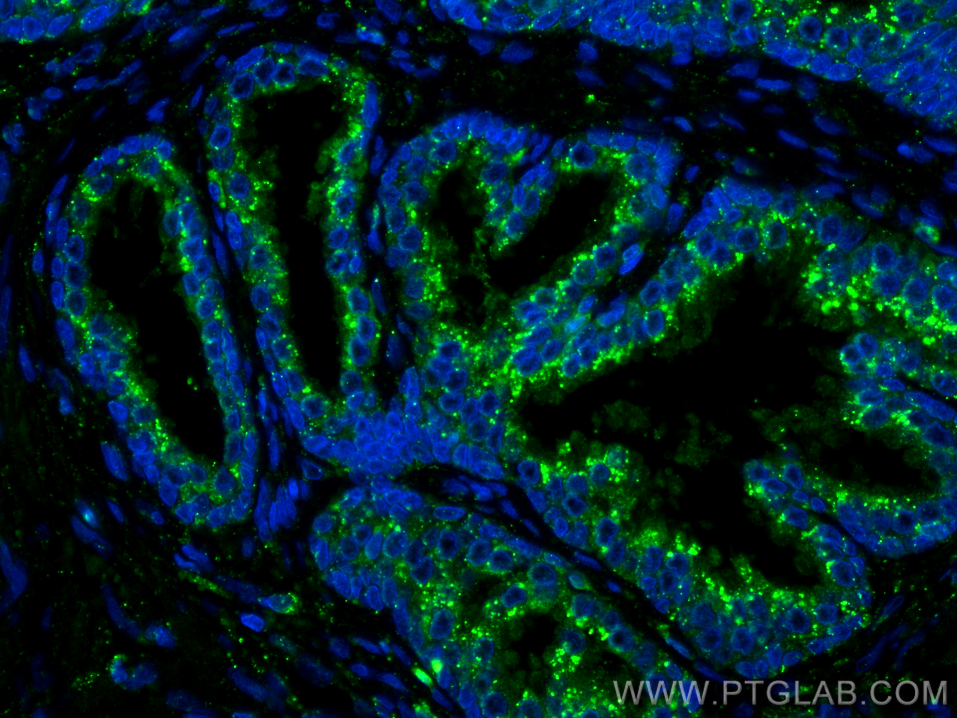 Immunofluorescence (IF) / fluorescent staining of human prostate cancer tissue using Beta Galactosidase Polyclonal antibody (15518-1-AP)