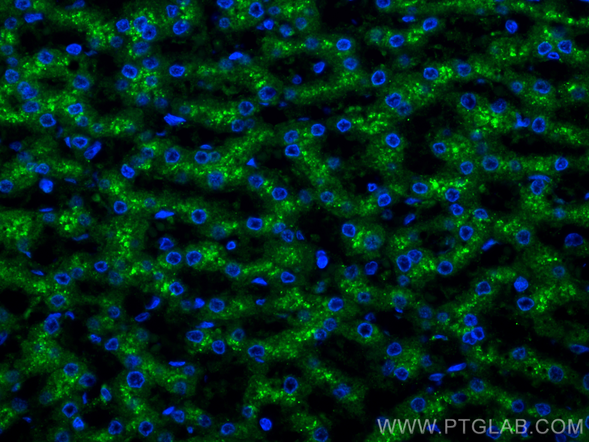 Immunofluorescence (IF) / fluorescent staining of human liver cancer tissue using Beta Galactosidase Polyclonal antibody (15518-1-AP)