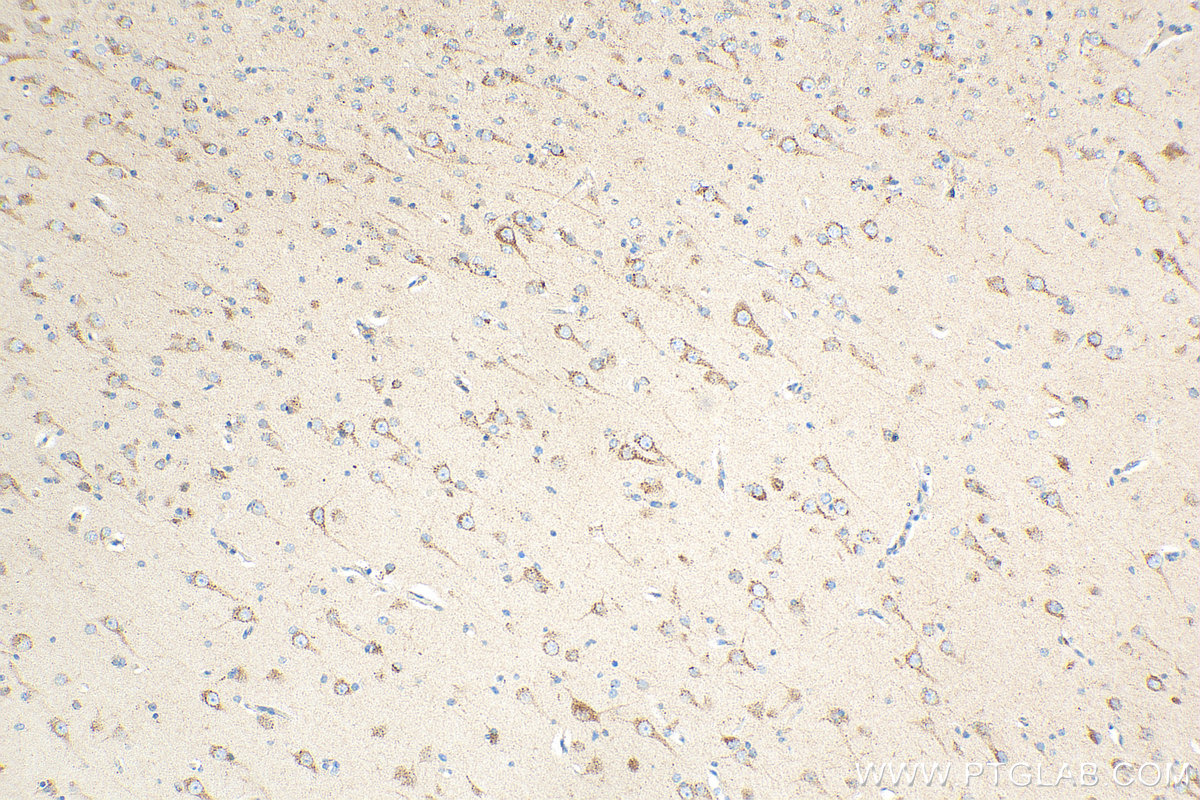 Immunohistochemistry (IHC) staining of human gliomas tissue using Beta Galactosidase Polyclonal antibody (15518-1-AP)