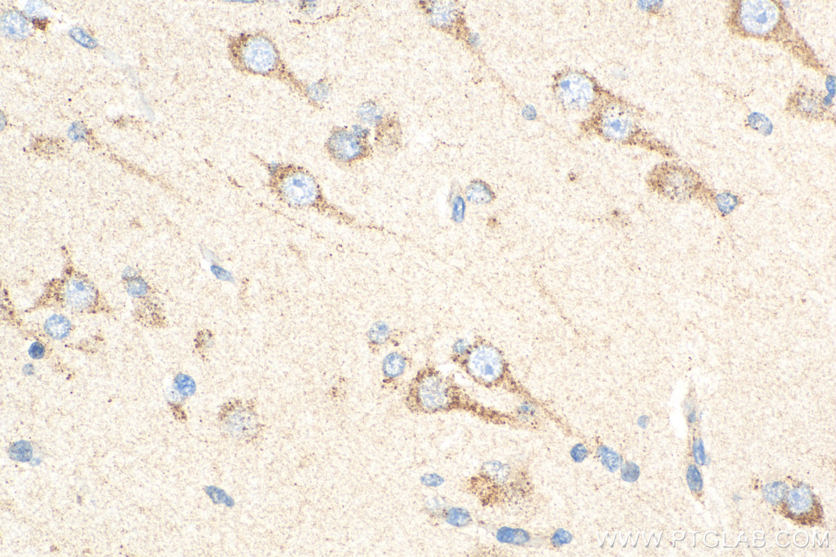 Immunohistochemistry (IHC) staining of human gliomas tissue using Beta Galactosidase Polyclonal antibody (15518-1-AP)