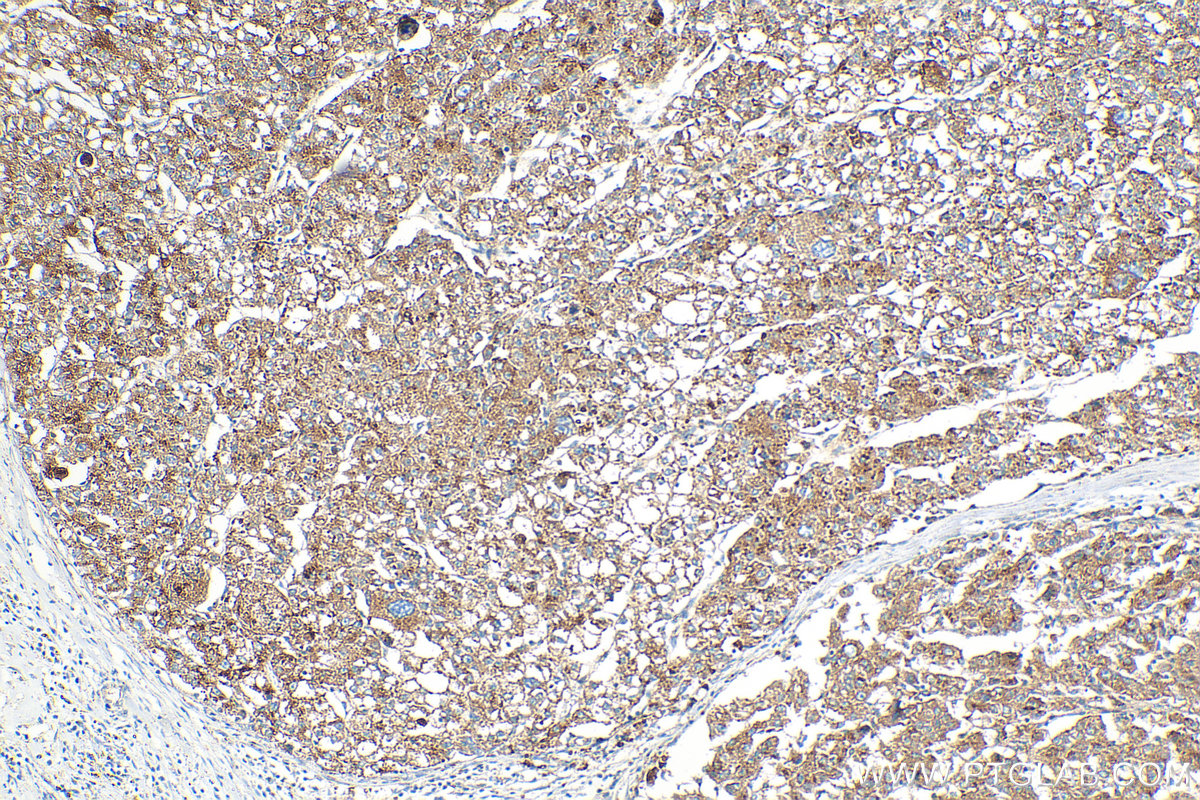 Immunohistochemistry (IHC) staining of human liver cancer tissue using Beta Galactosidase Polyclonal antibody (15518-1-AP)