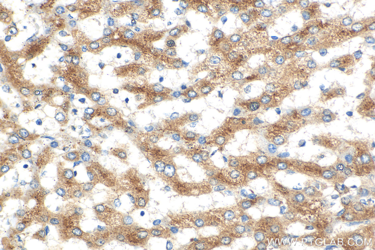 Immunohistochemistry (IHC) staining of human liver cancer tissue using Beta Galactosidase Polyclonal antibody (15518-1-AP)