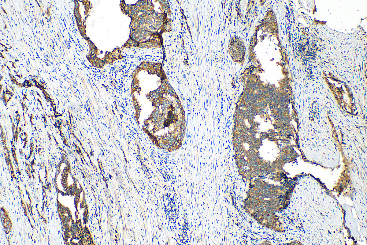 Immunohistochemistry (IHC) staining of human prostate cancer tissue using Beta Galactosidase Polyclonal antibody (15518-1-AP)