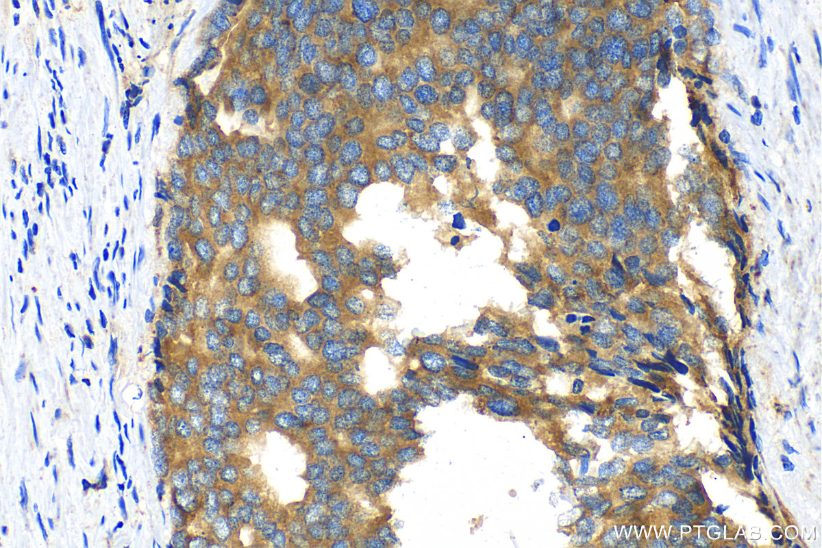 Immunohistochemistry (IHC) staining of human prostate cancer tissue using Beta Galactosidase Polyclonal antibody (15518-1-AP)