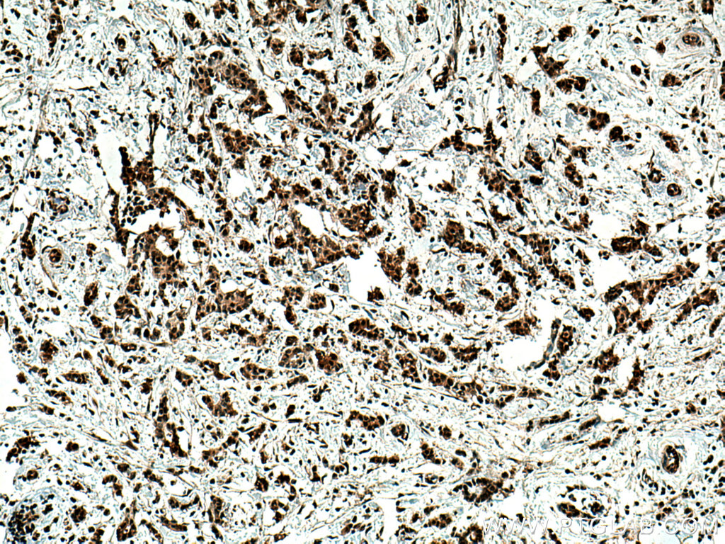 Immunohistochemistry (IHC) staining of human breast cancer tissue using GLI2 Polyclonal antibody (28245-1-AP)