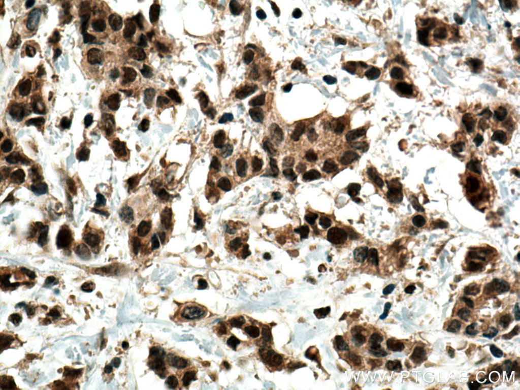 Immunohistochemistry (IHC) staining of human breast cancer tissue using GLI2 Polyclonal antibody (28245-1-AP)