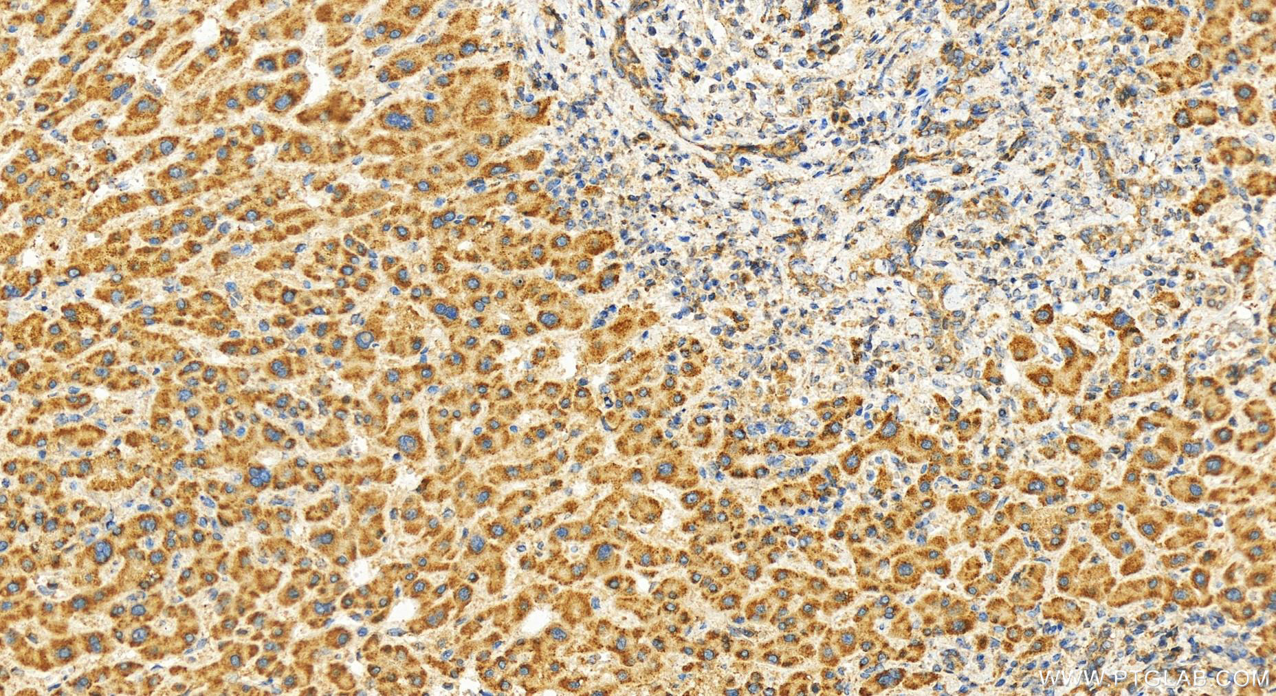 Immunohistochemistry (IHC) staining of human intrahepatic cholangiocarcinoma tissue using GLT25D2 Polyclonal antibody (25993-1-AP)