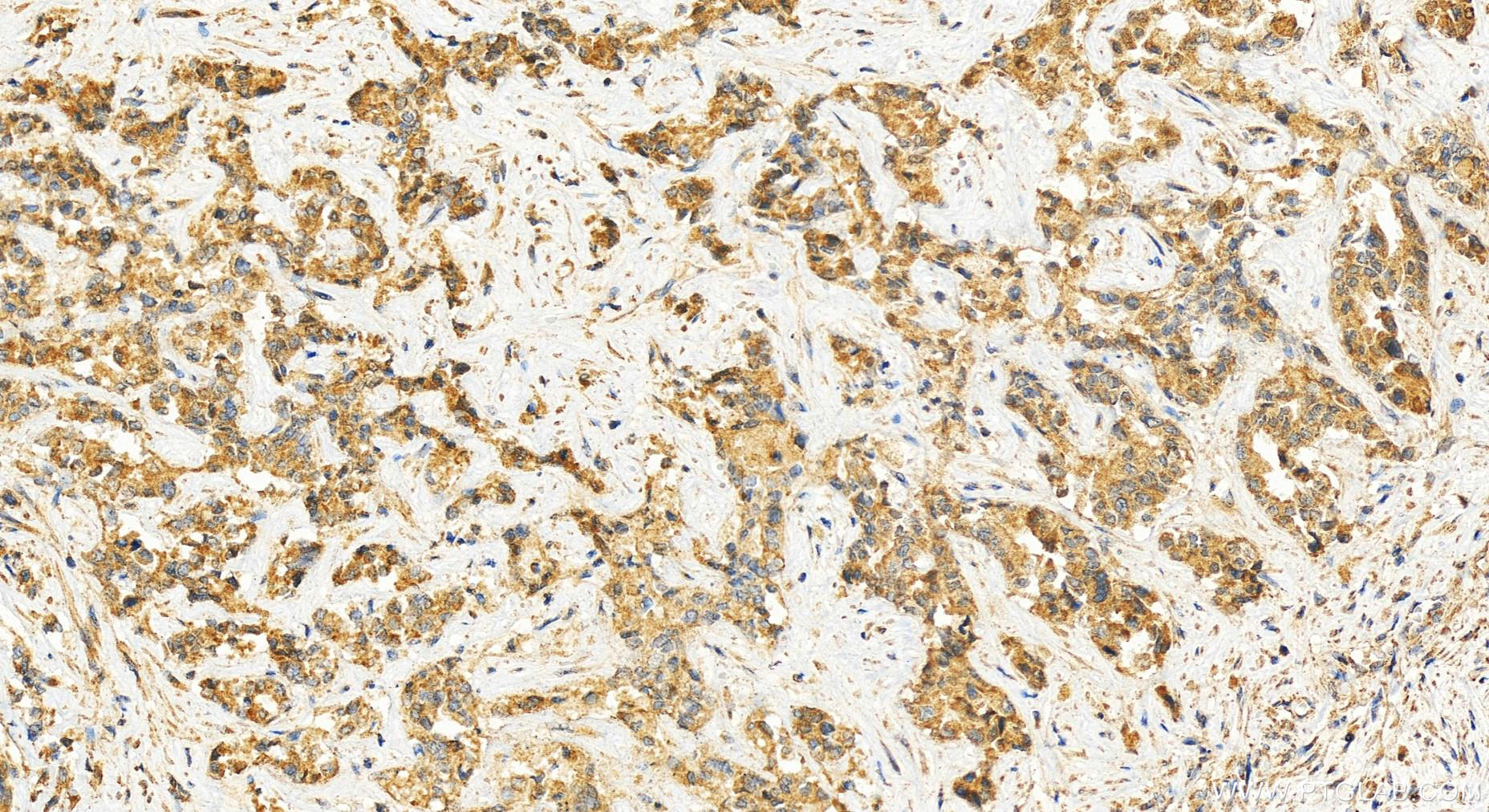 Immunohistochemistry (IHC) staining of human intrahepatic cholangiocarcinoma tissue using GLT25D2 Polyclonal antibody (25993-1-AP)