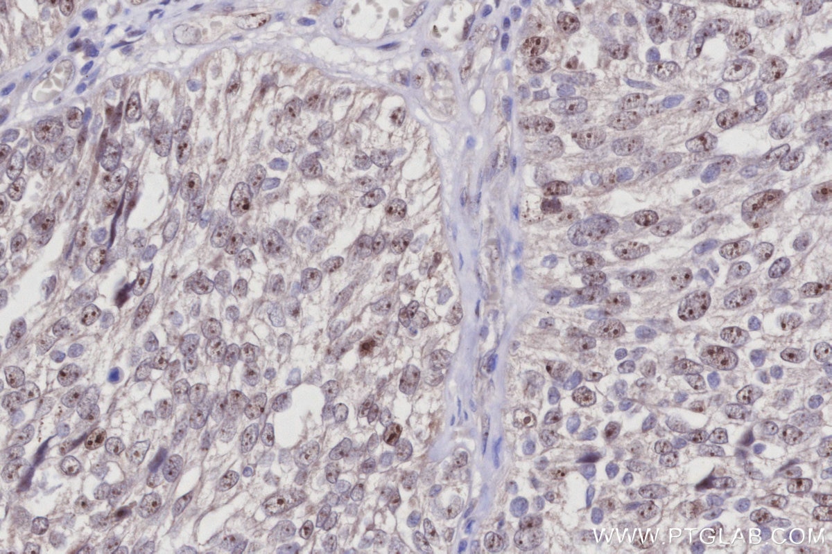 Immunohistochemistry (IHC) staining of human ovary cancer tissue using GLTSCR2 Polyclonal antibody (27353-1-AP)